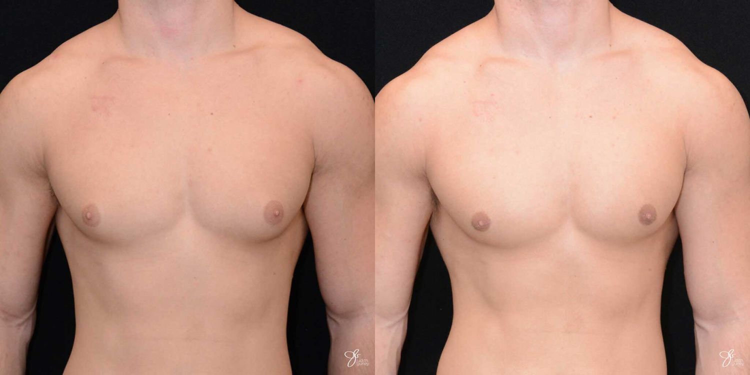 Gynecomastia Correction Before & After