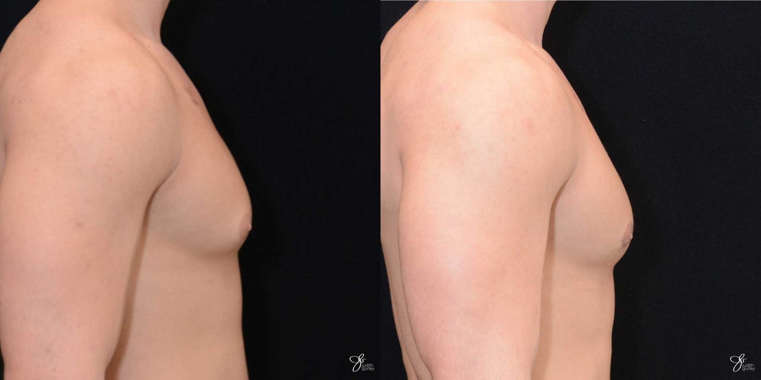 Gynecomastia Correction Before & After