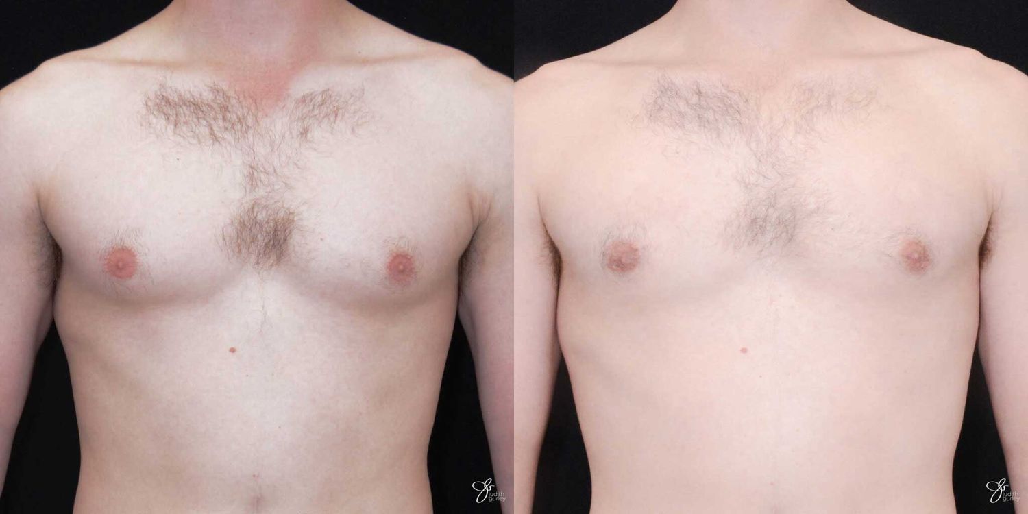 Gynecomastia Correction Before & After