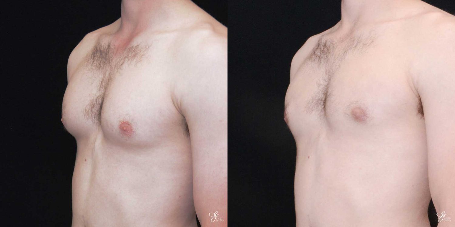 Gynecomastia Correction Before & After