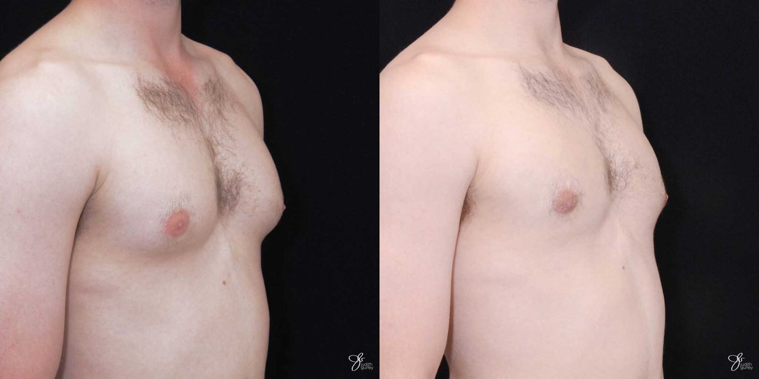 Gynecomastia Correction Before & After