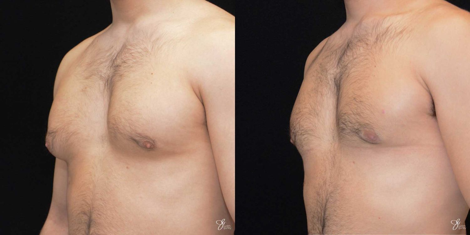 Gynecomastia Correction Before & After