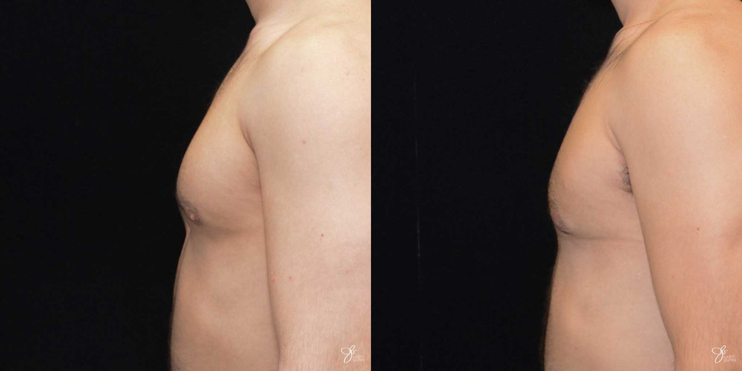 Gynecomastia Correction Before & After
