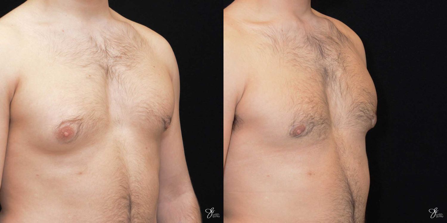 Gynecomastia Correction Before & After
