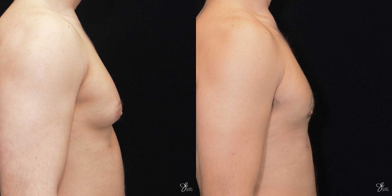 Gynecomastia Correction Before & After