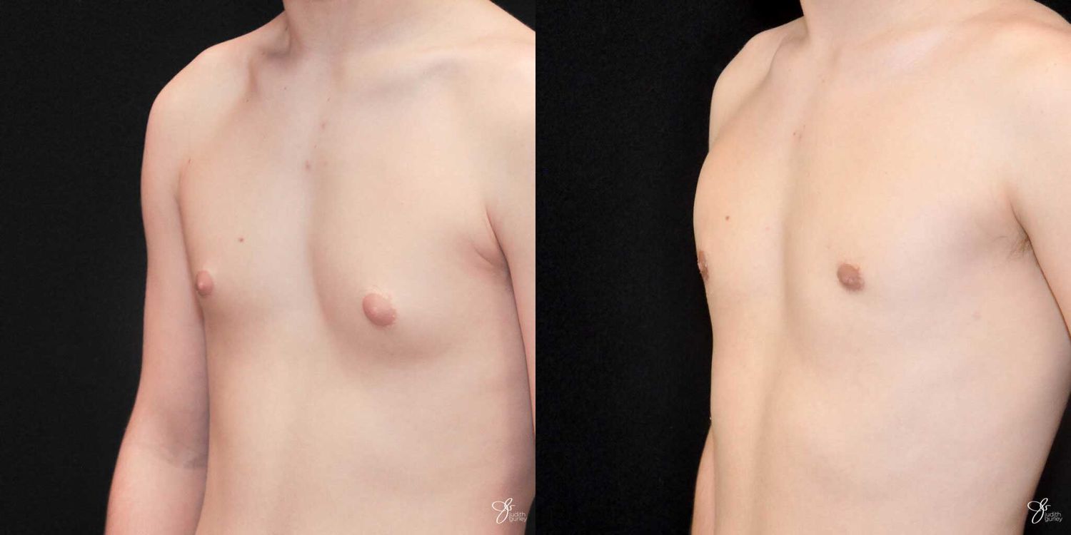 Gynecomastia Correction Before & After
