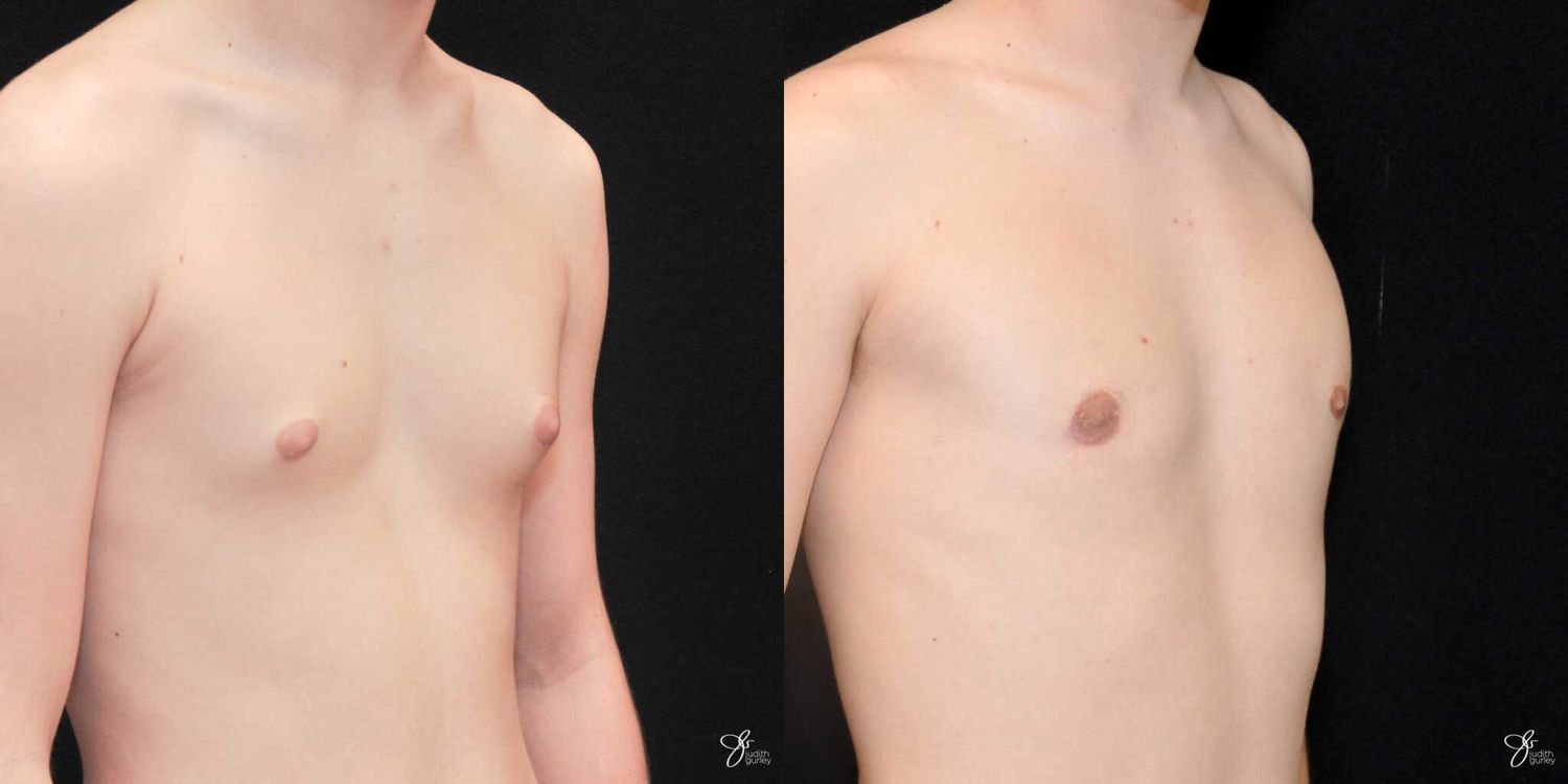 Gynecomastia Correction Before & After