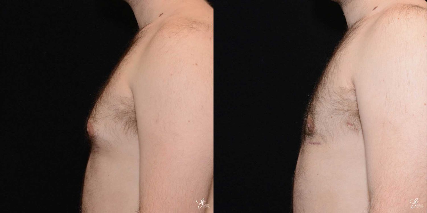 Gynecomastia Correction Before & After