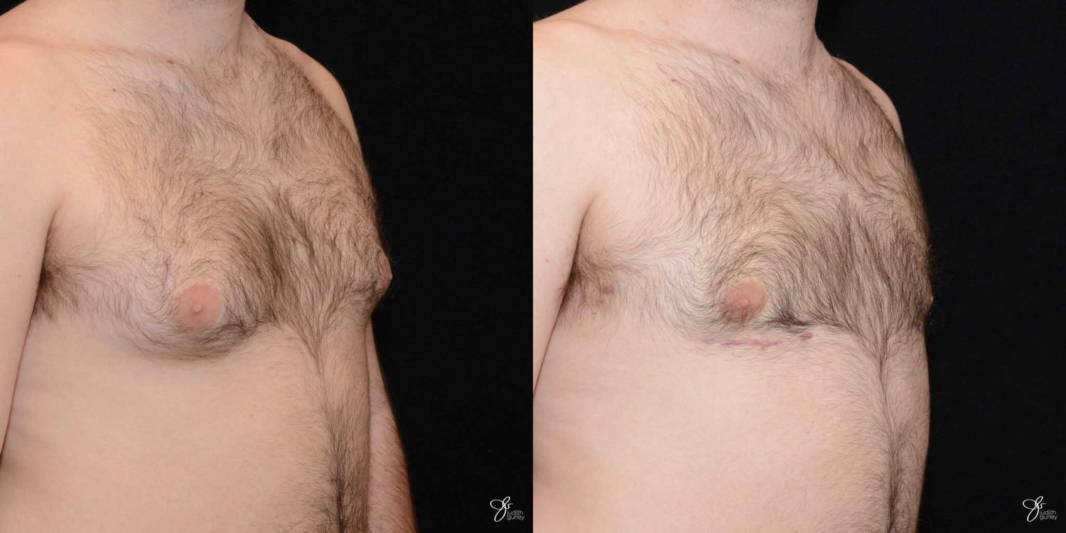 Gynecomastia Correction Before & After