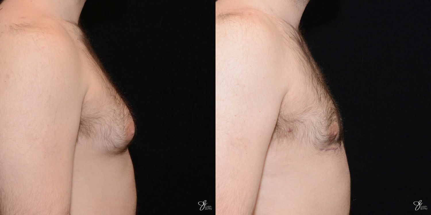 Gynecomastia Correction Before & After