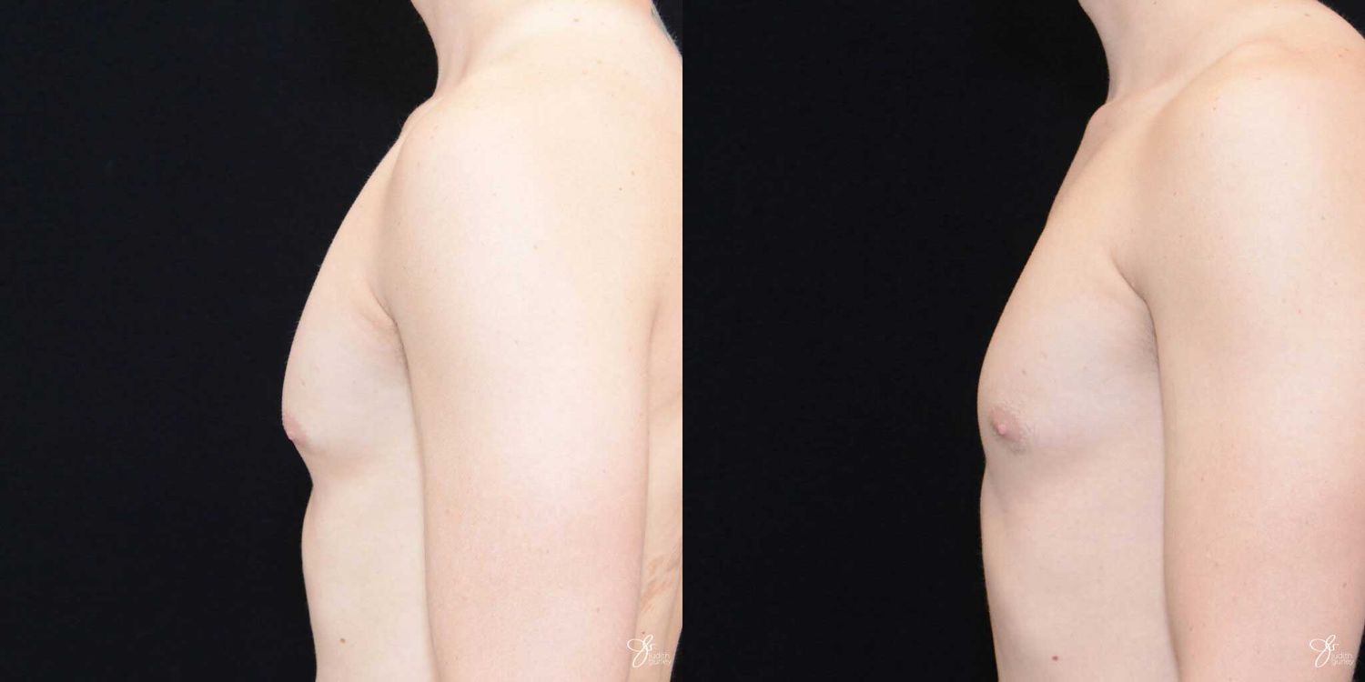 Gynecomastia Correction Before & After