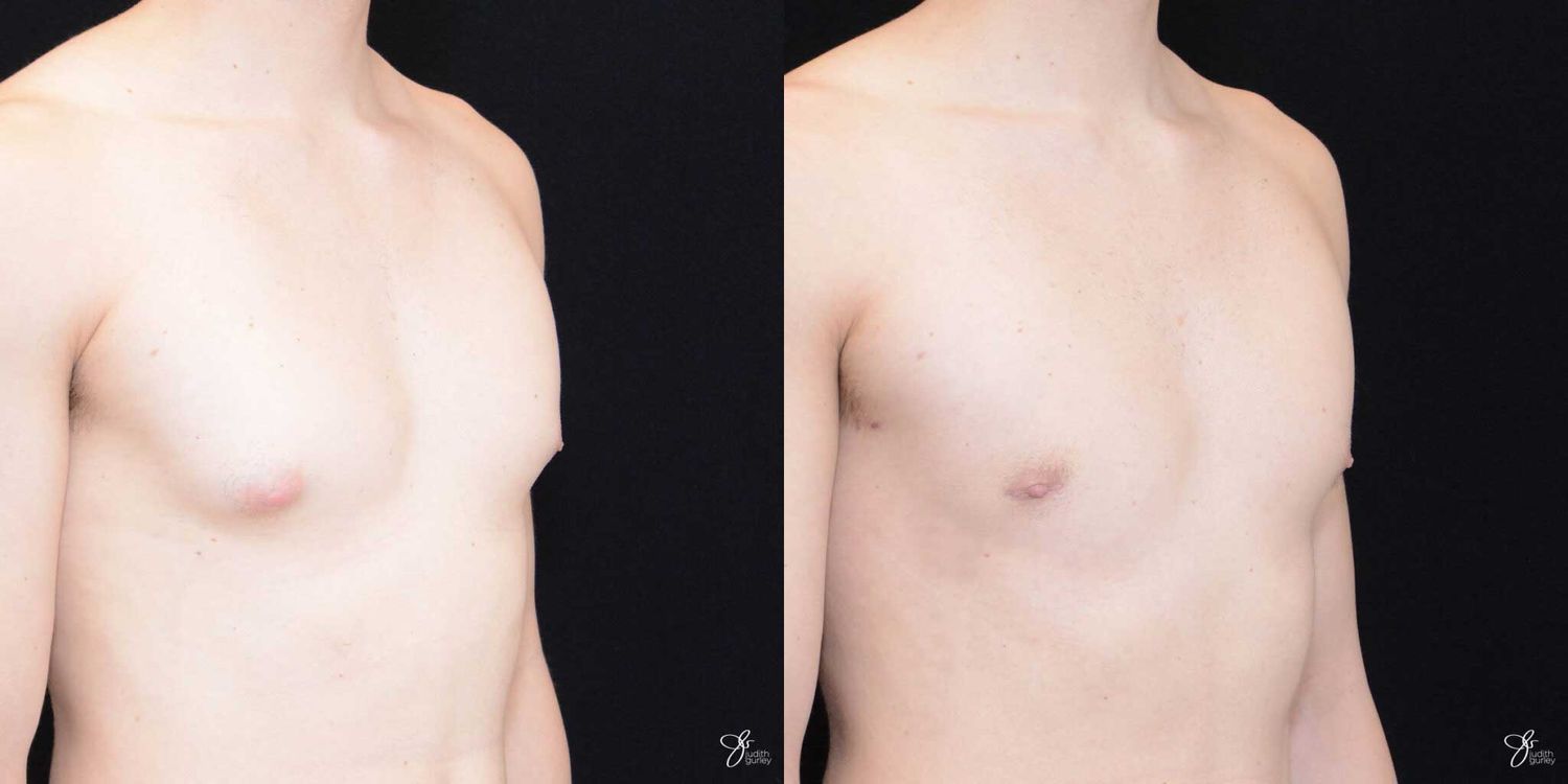 Gynecomastia Correction Before & After