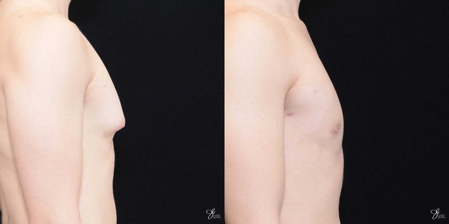 Gynecomastia Correction Before & After