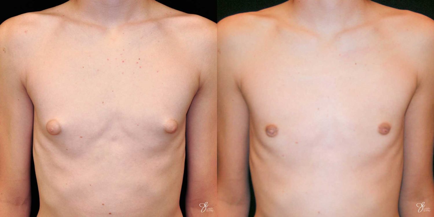 Gynecomastia Correction Before & After
