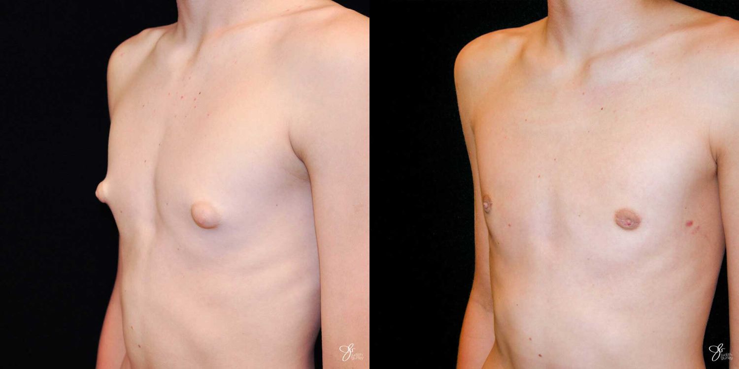 Gynecomastia Correction Before & After