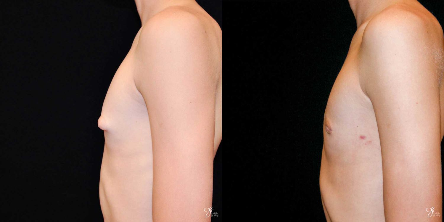Gynecomastia Correction Before & After