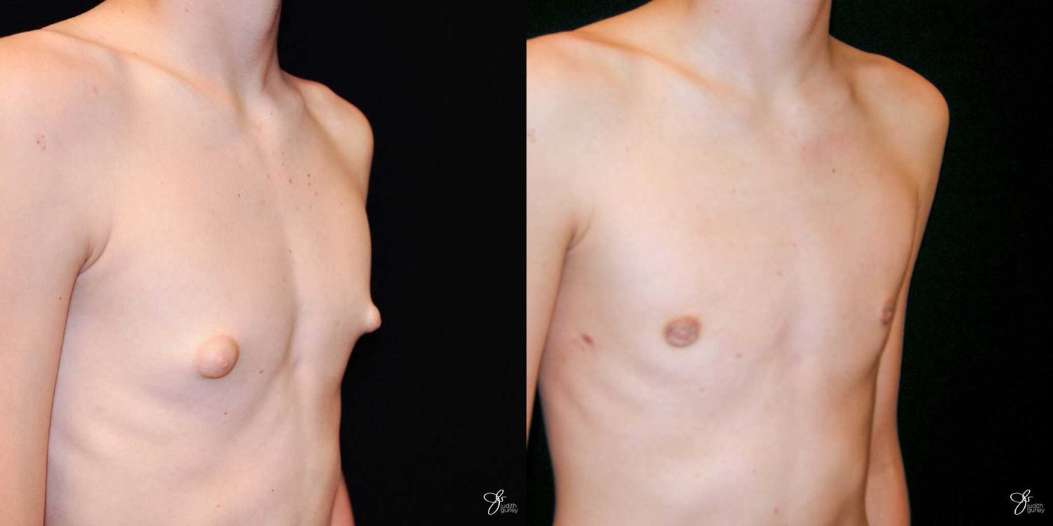 Gynecomastia Correction Before & After