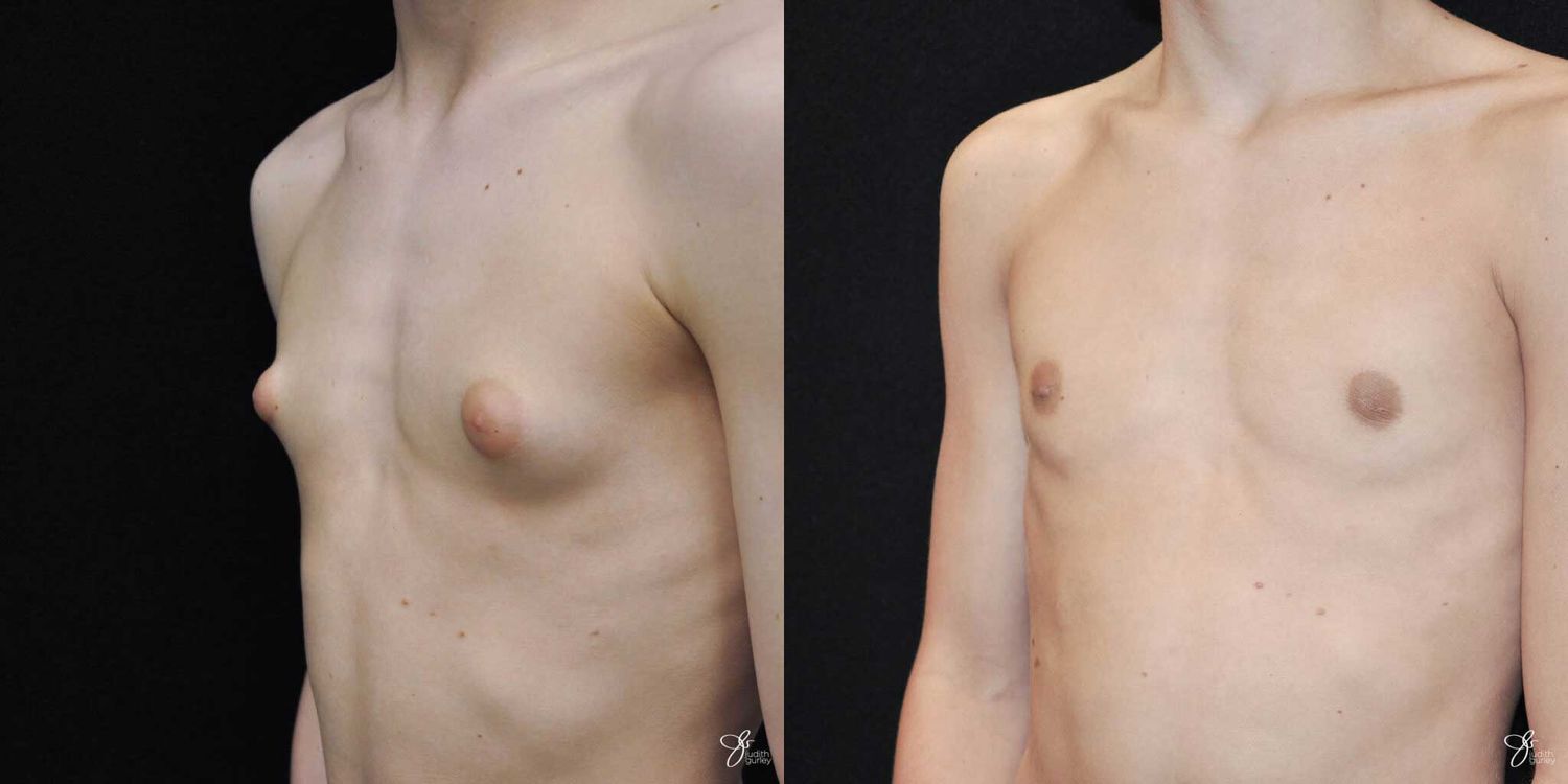 Gynecomastia Correction Before & After
