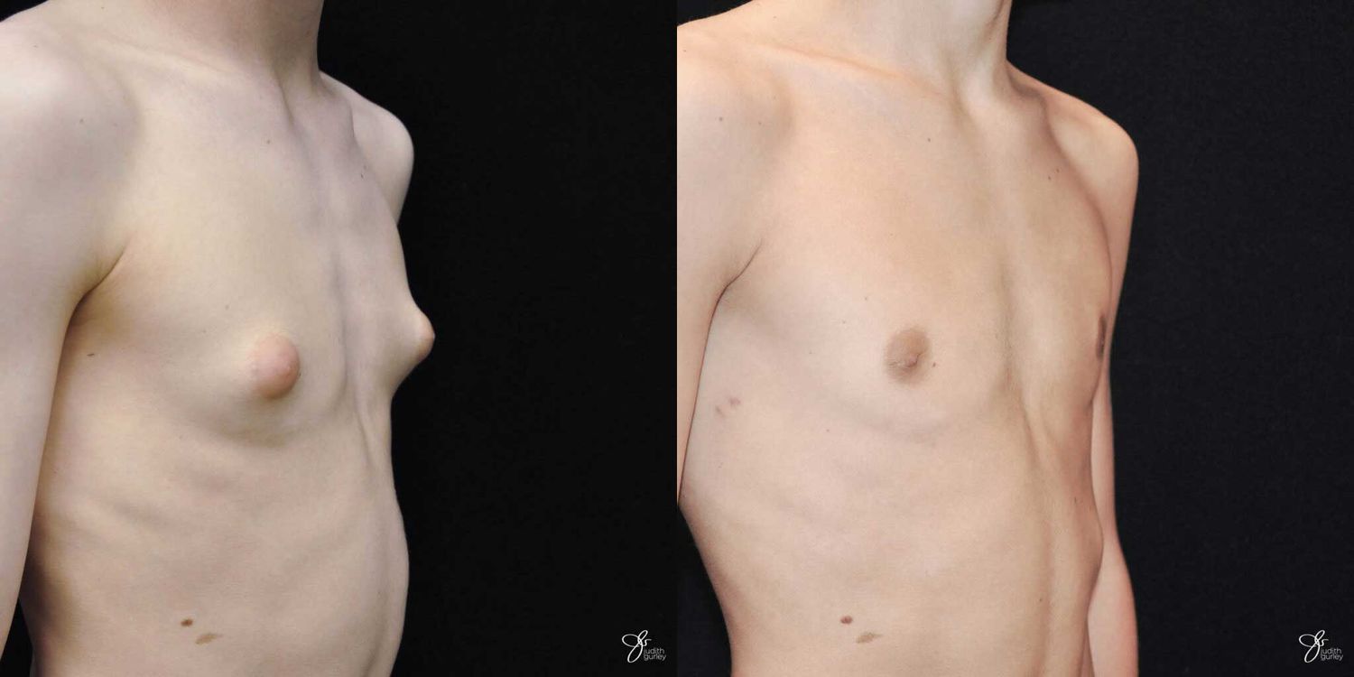 Gynecomastia Correction Before & After