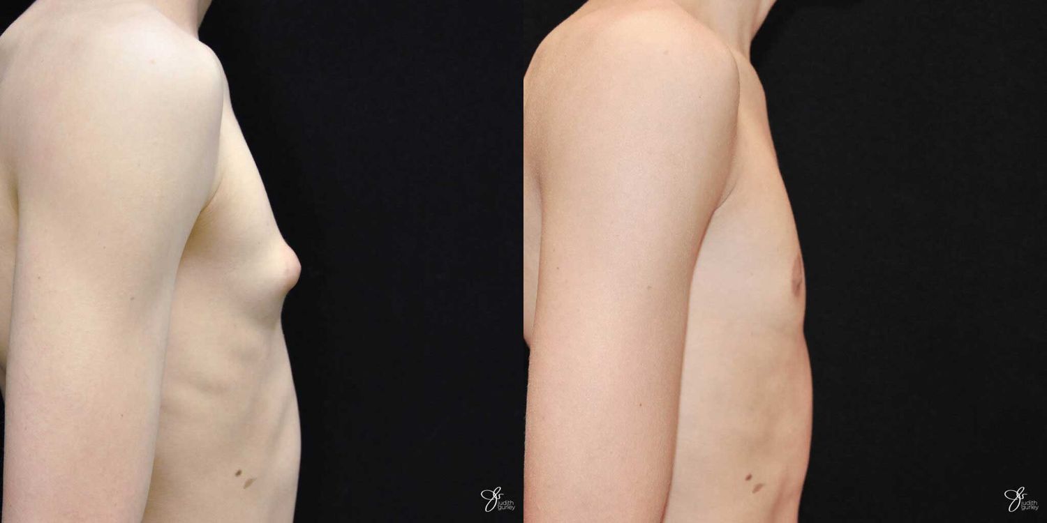Gynecomastia Correction Before & After