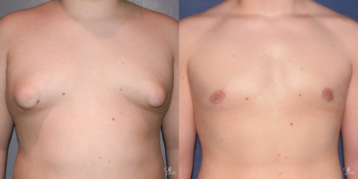 Gynecomastia Correction Before & After