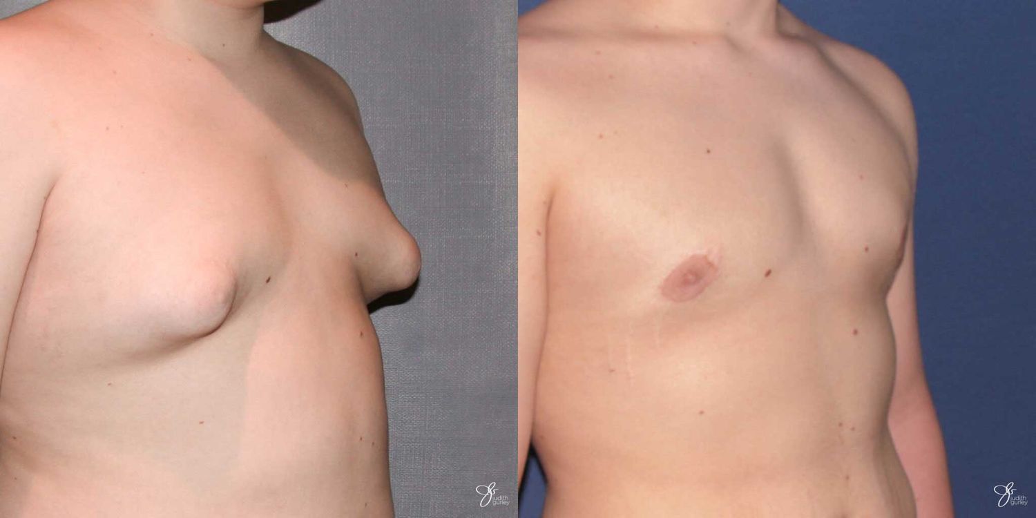 Gynecomastia Correction Before & After