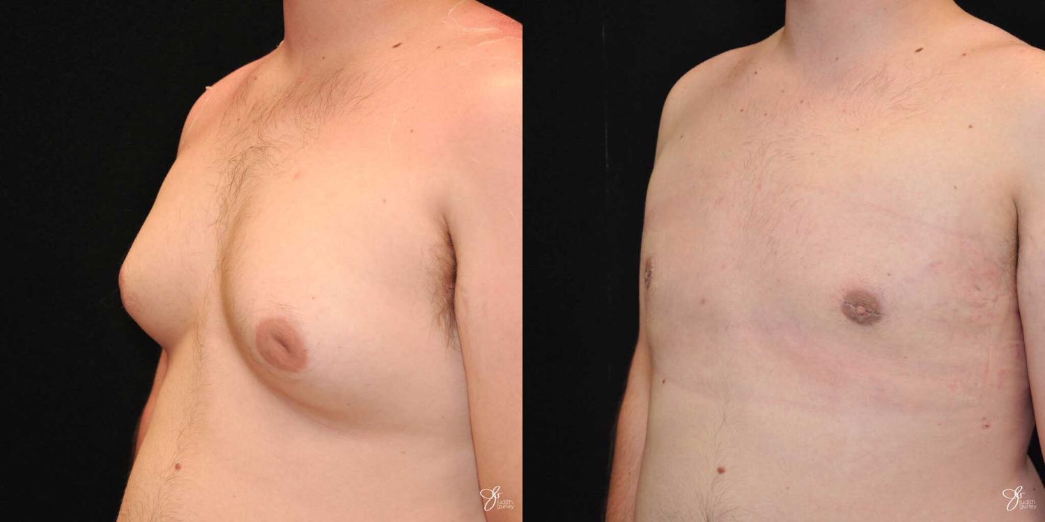 Gynecomastia Correction Before & After
