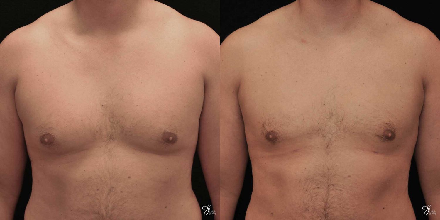 Gynecomastia Correction Before & After