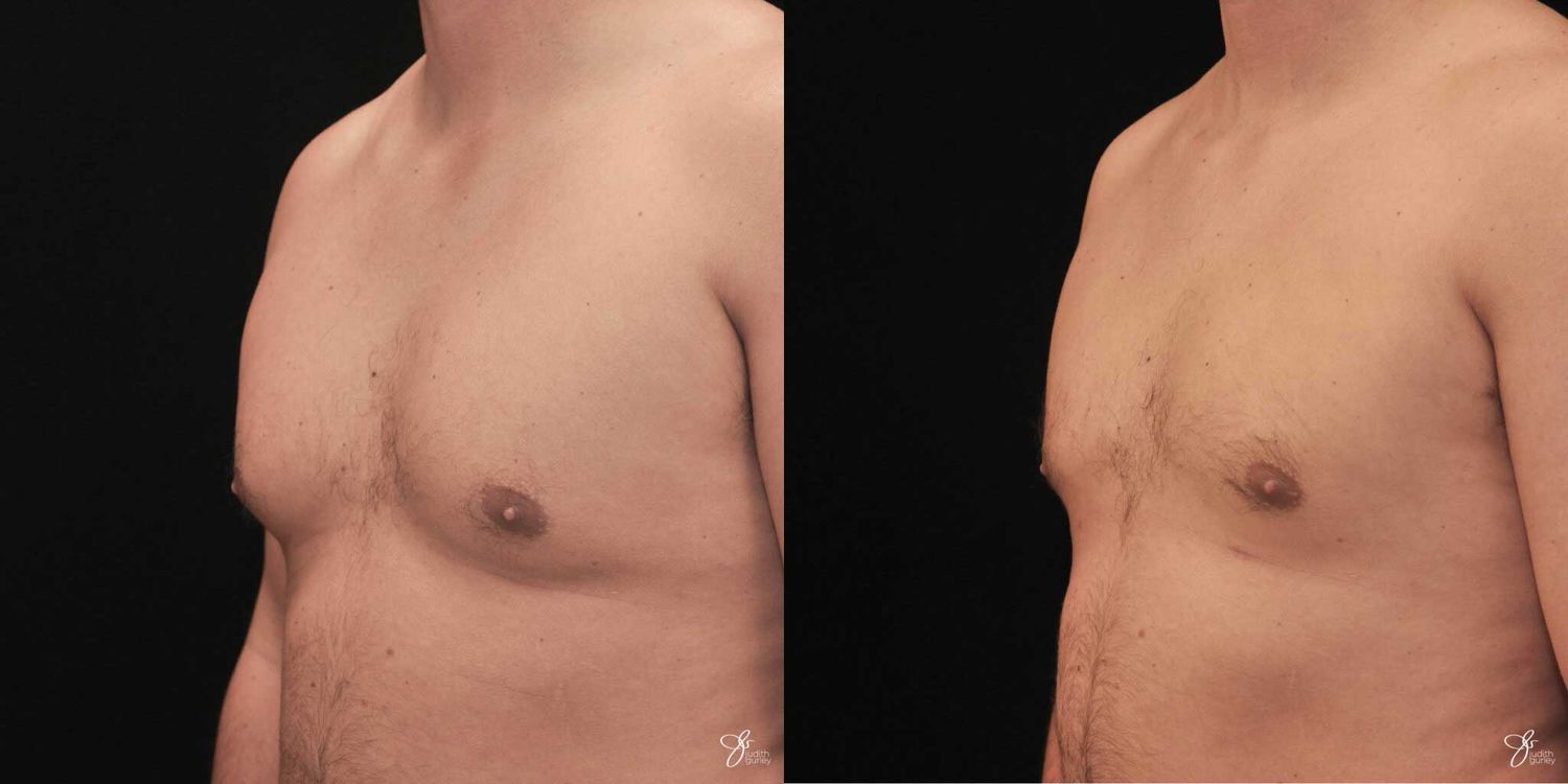 Gynecomastia Correction Before & After