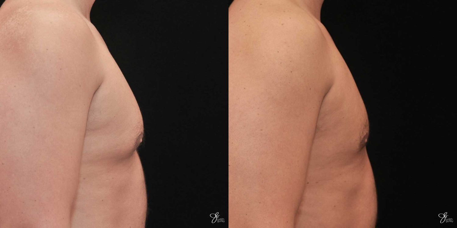 Gynecomastia Correction Before & After