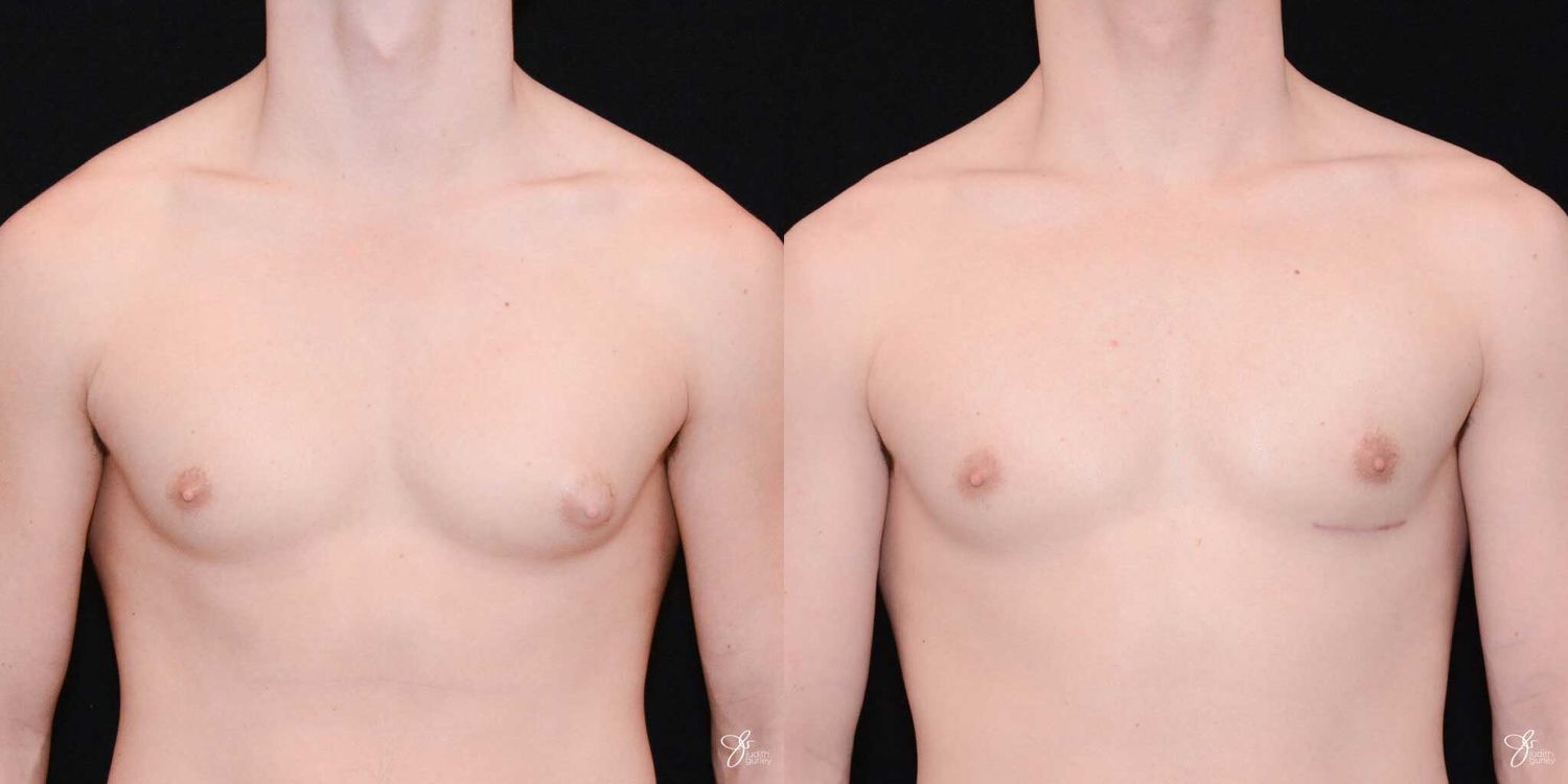 Gynecomastia Correction Before & After