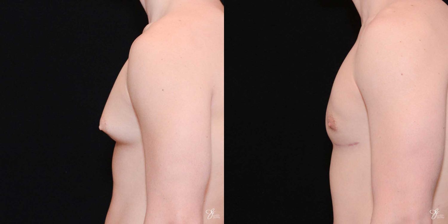 Gynecomastia Correction Before & After