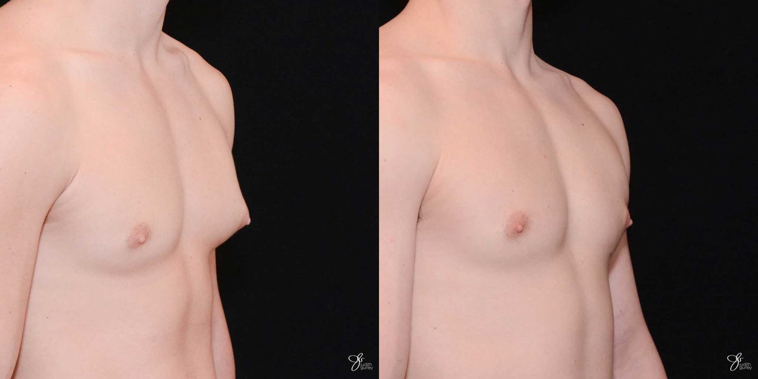 Gynecomastia Correction Before & After