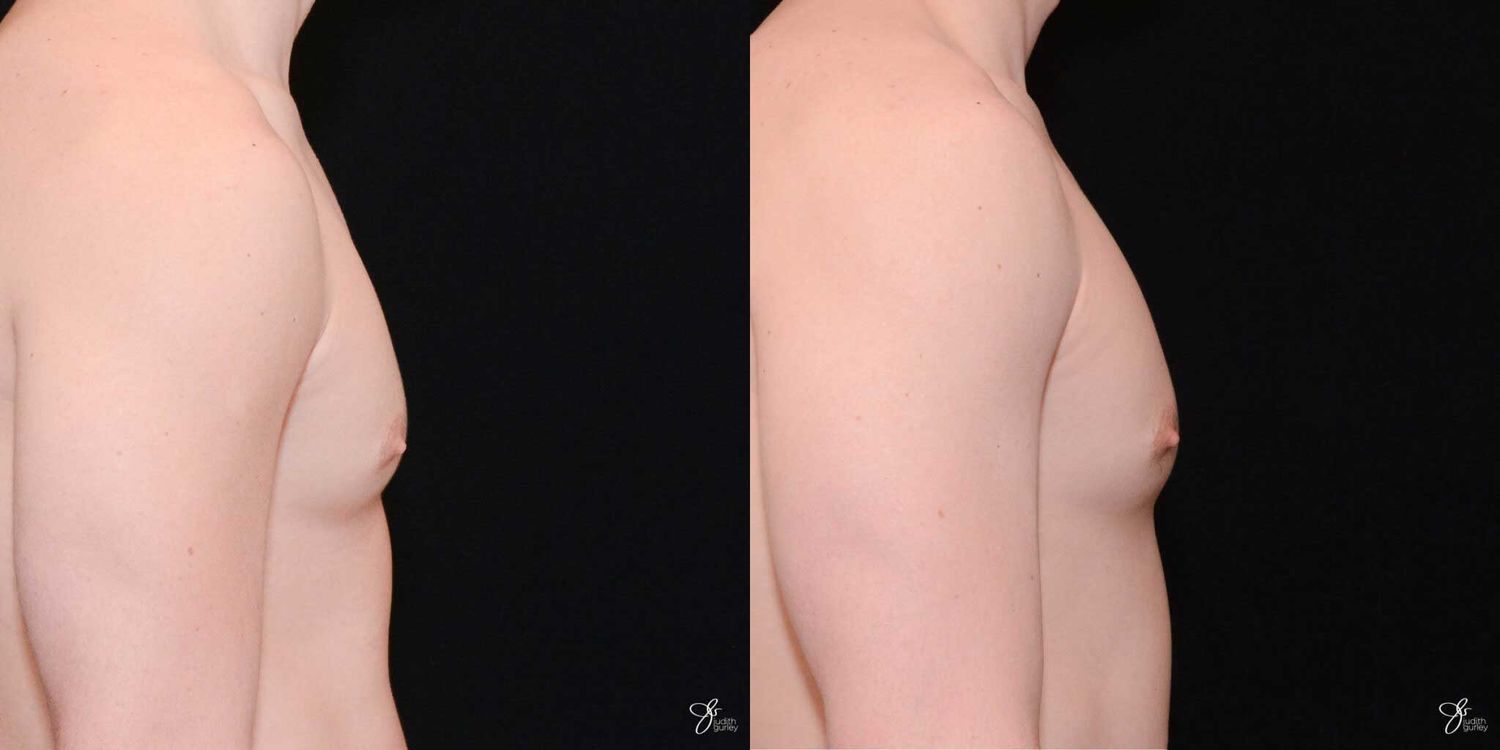 Gynecomastia Correction Before & After