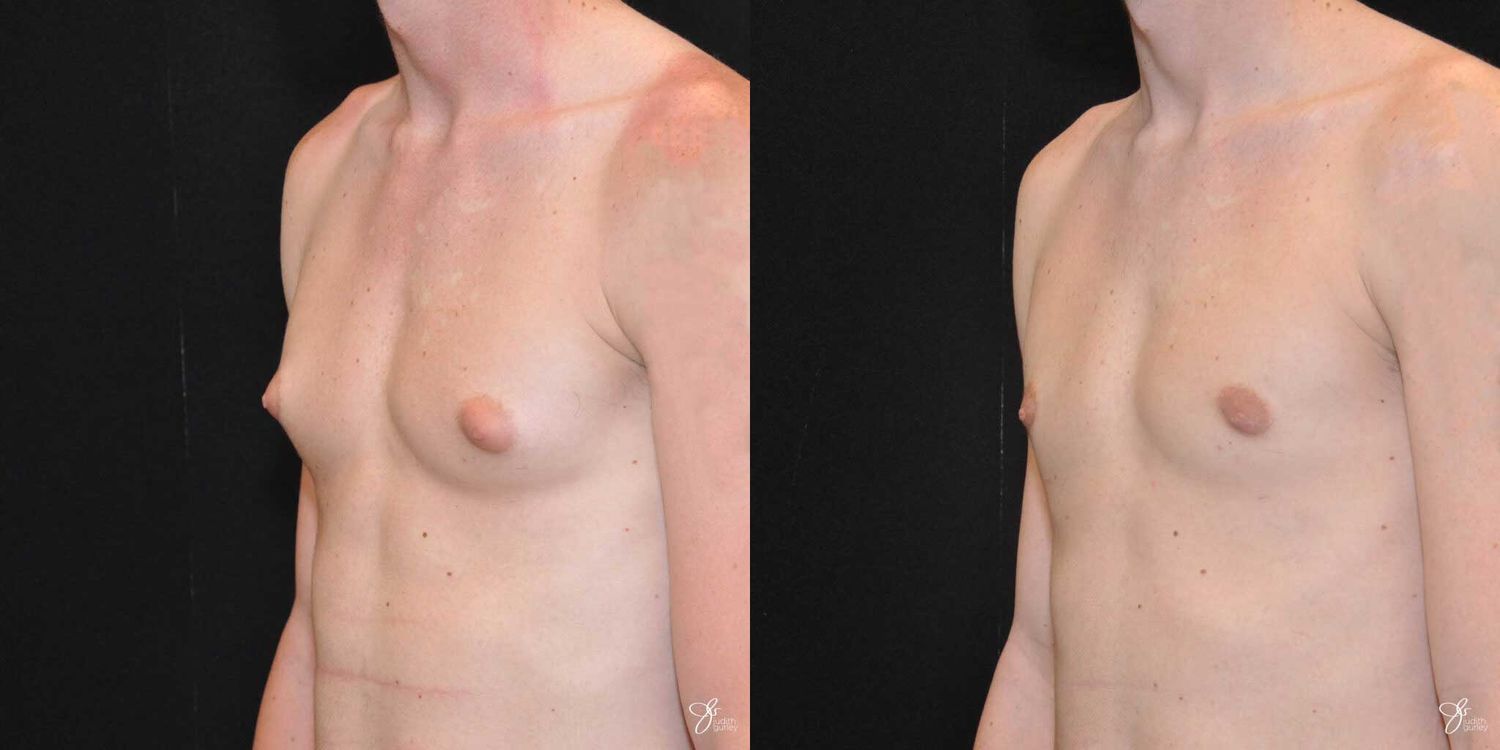 Gynecomastia Correction Before & After