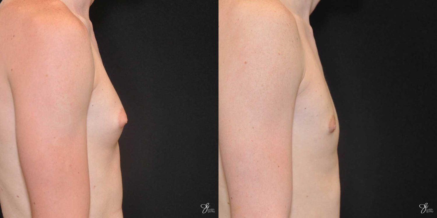 Gynecomastia Correction Before & After