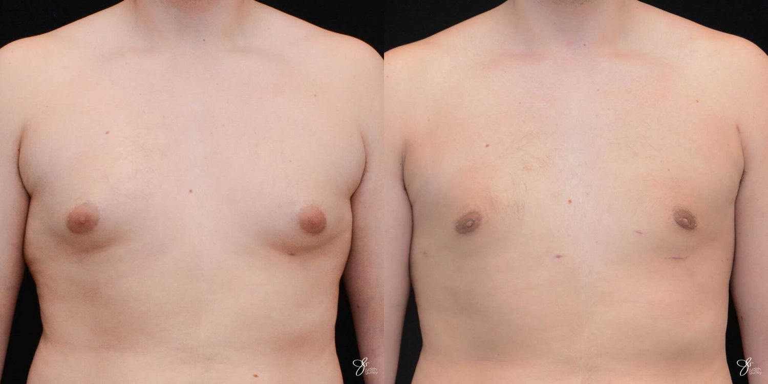 Gynecomastia Correction Before & After