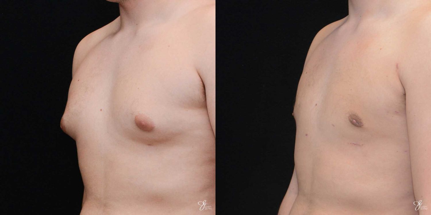 Gynecomastia Correction Before & After
