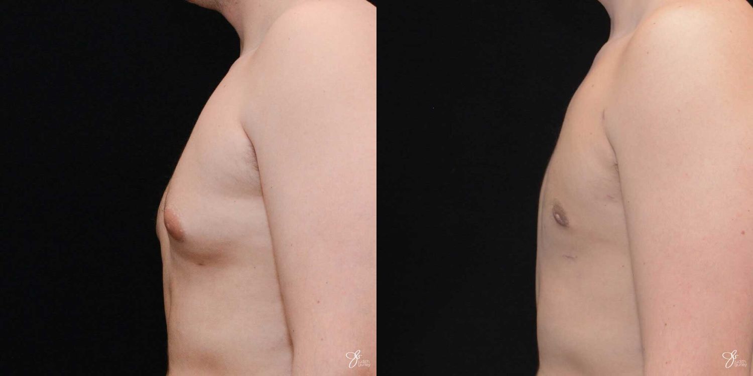 Gynecomastia Correction Before & After