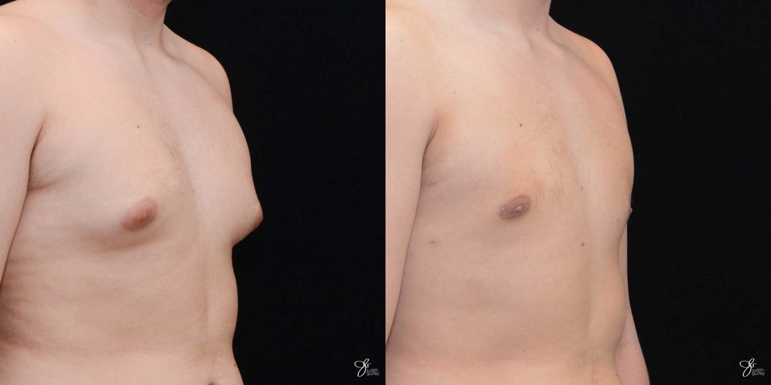 Gynecomastia Correction Before & After
