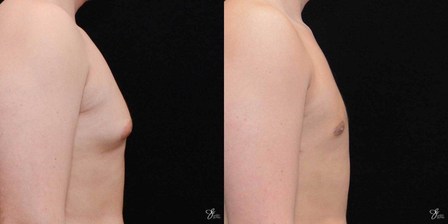 Gynecomastia Correction Before & After