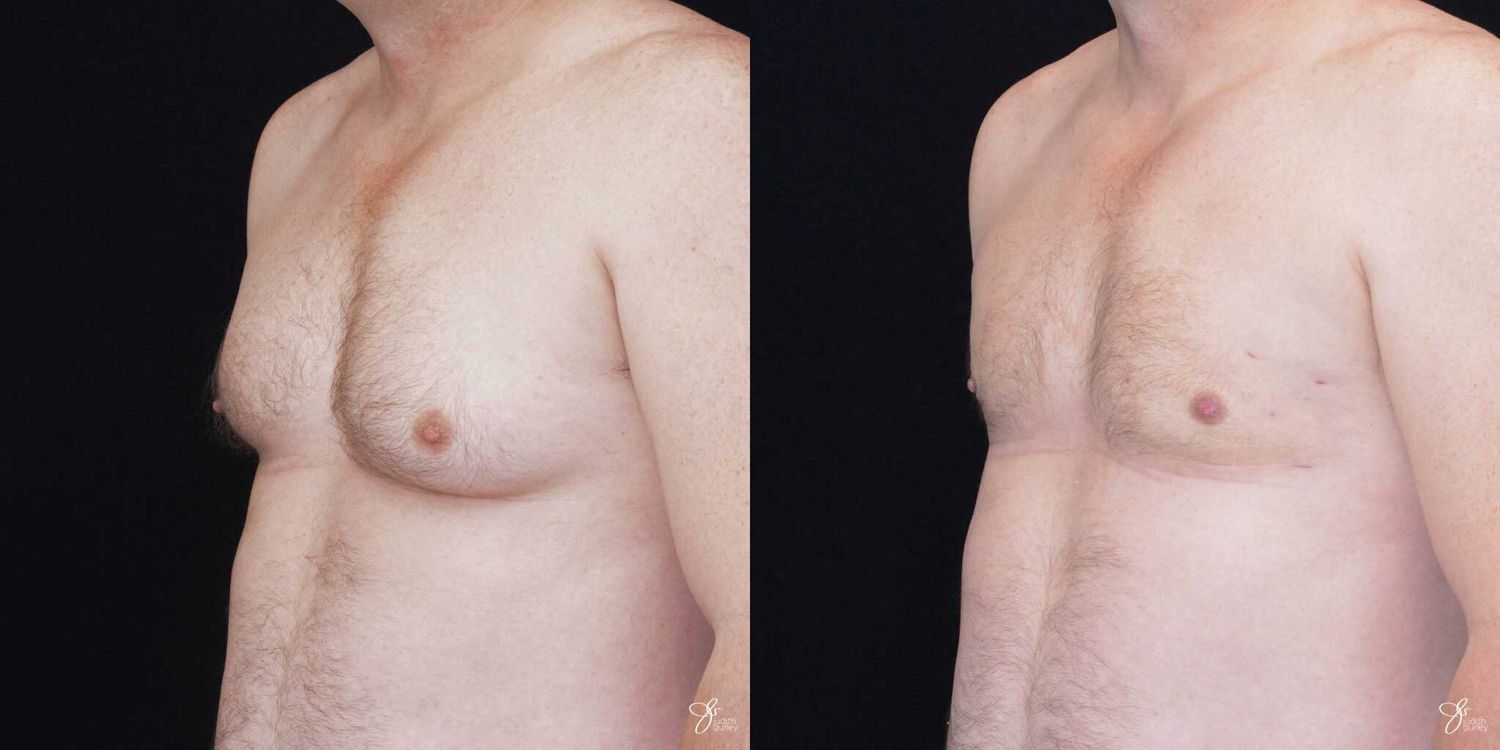 Gynecomastia Correction Before & After