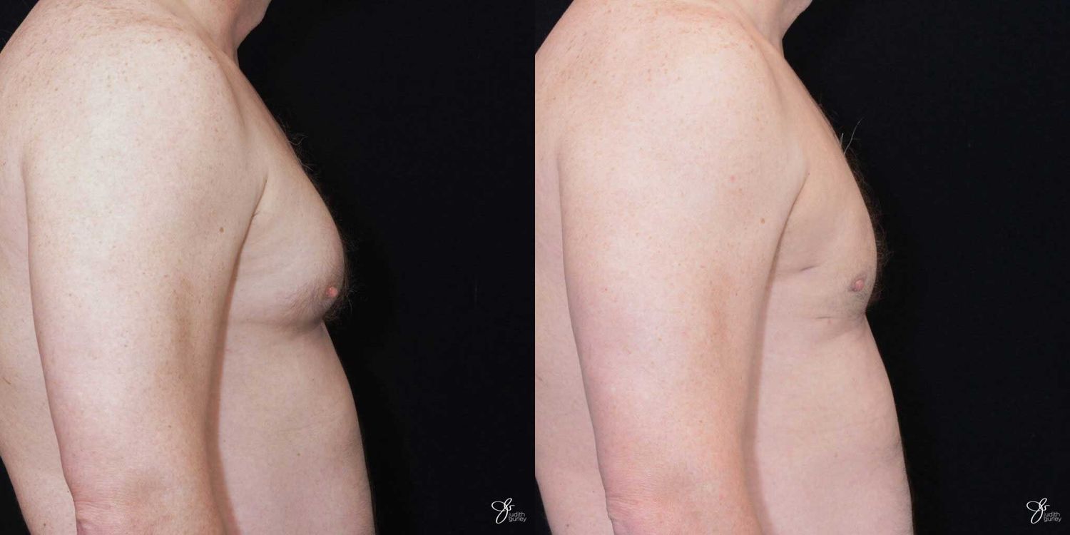 Gynecomastia Correction Before & After