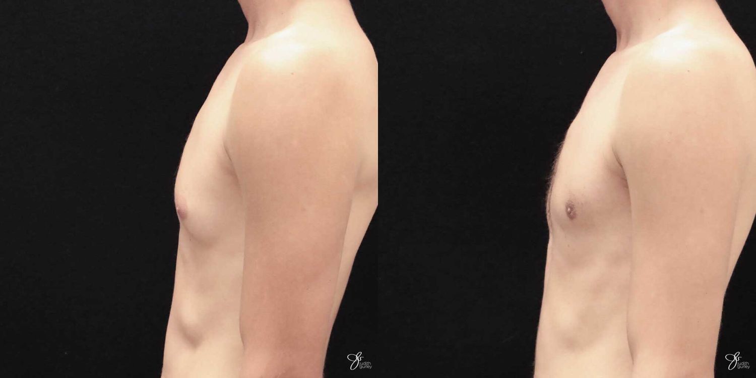 Gynecomastia Correction Before & After