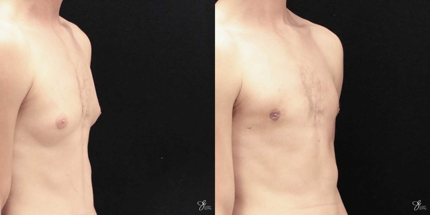 Gynecomastia Correction Before & After