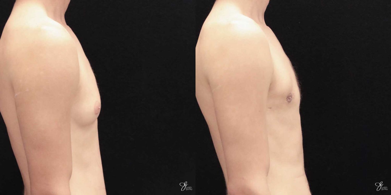 Gynecomastia Correction Before & After
