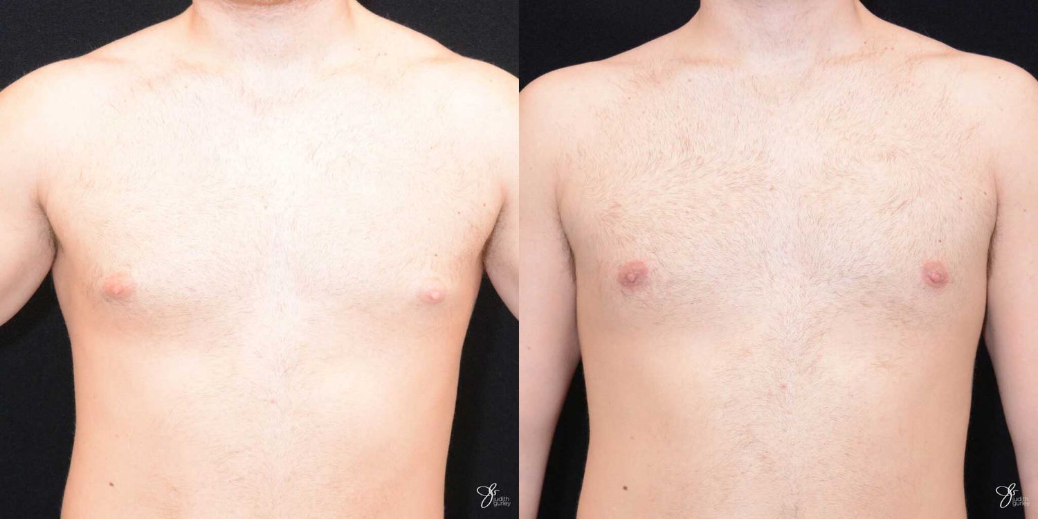 Gynecomastia Correction Before & After
