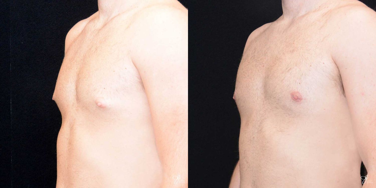 Gynecomastia Correction Before & After