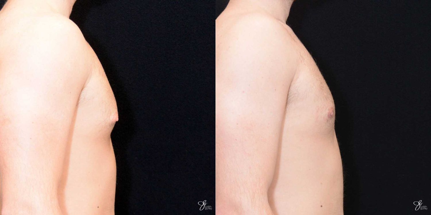 Gynecomastia Correction Before & After