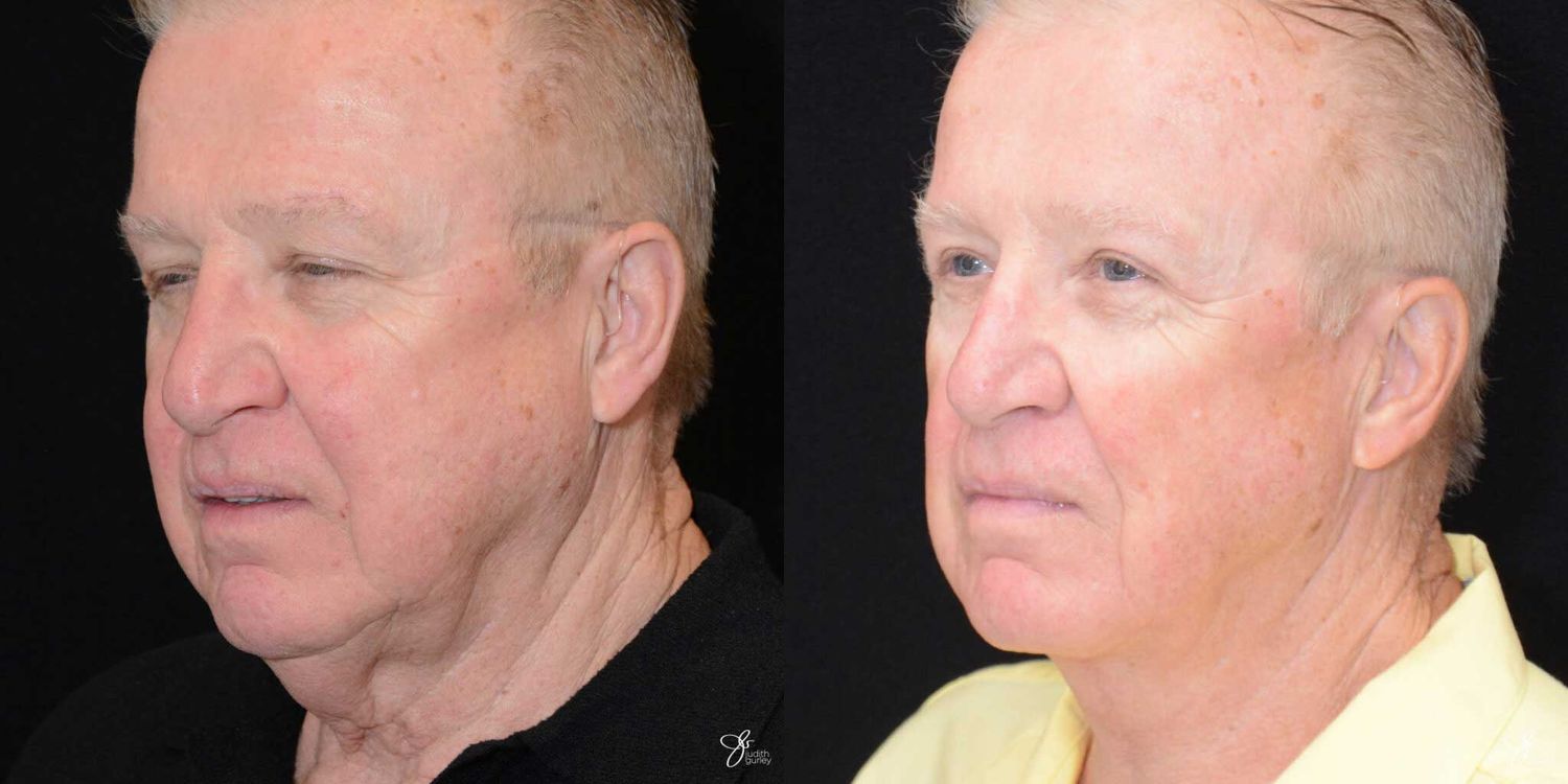 Face And Neck Lifts Before & After